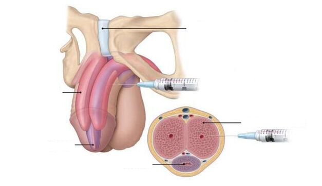 potency-enhancing injections